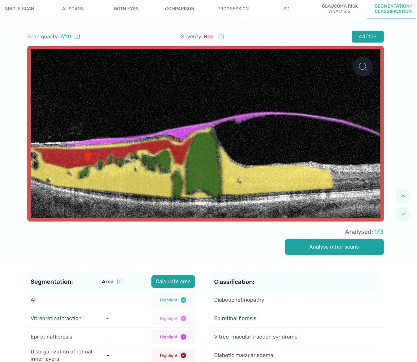 optical-coherence-tomography-varcoe-eyecare-optometrists