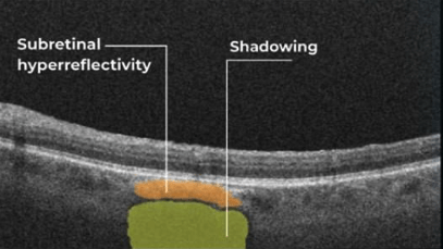 OCT Examination VS Fundus Photography: What To Choose