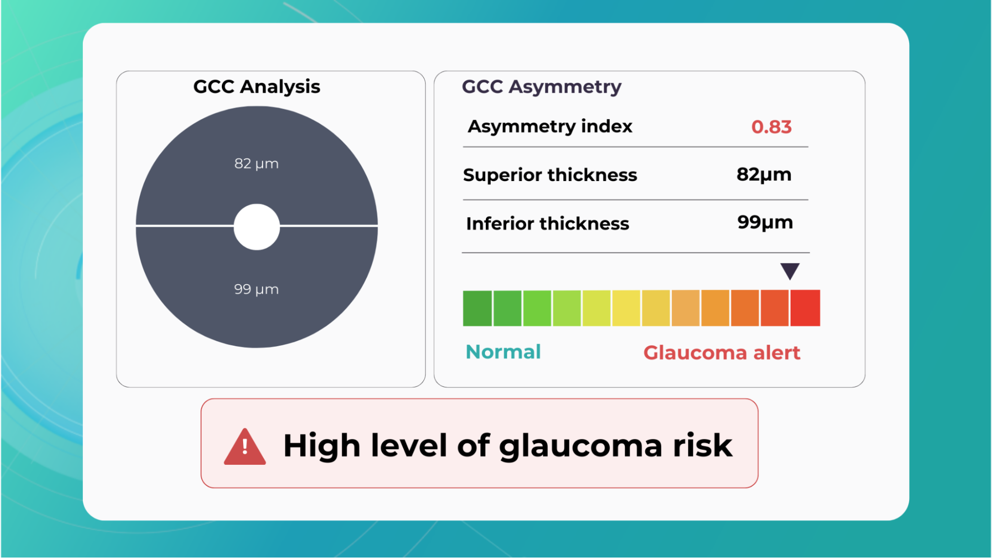 Altris AI's Early glaucoma risk assessment module 
