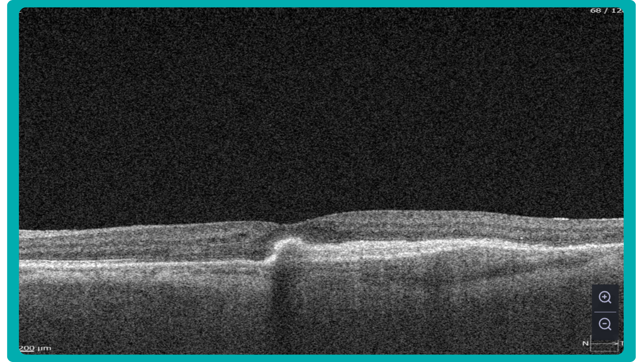 Wet AMD on OCT scan, example provided by ALtris AI platform