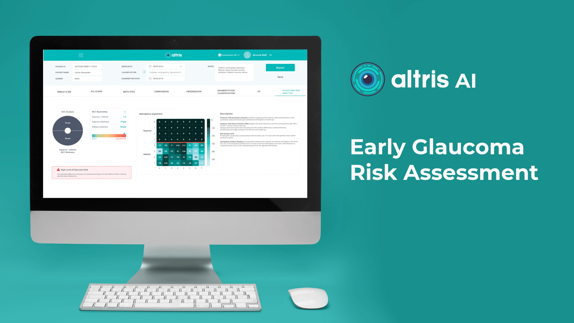 Early glaucoma risk assessment module by Altris AI