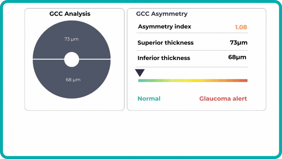 Early glaucoma risk assessment by Altris AI