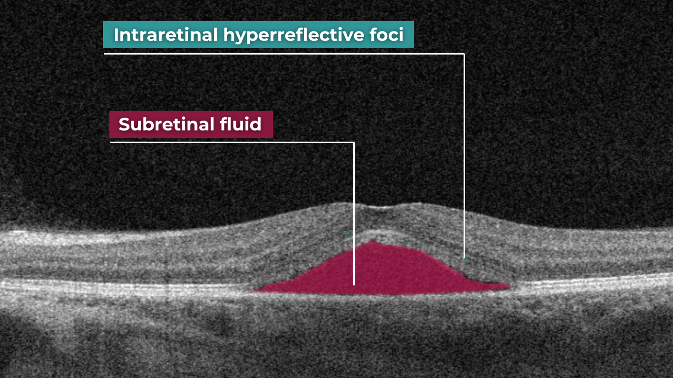 normal abnormal oct scan