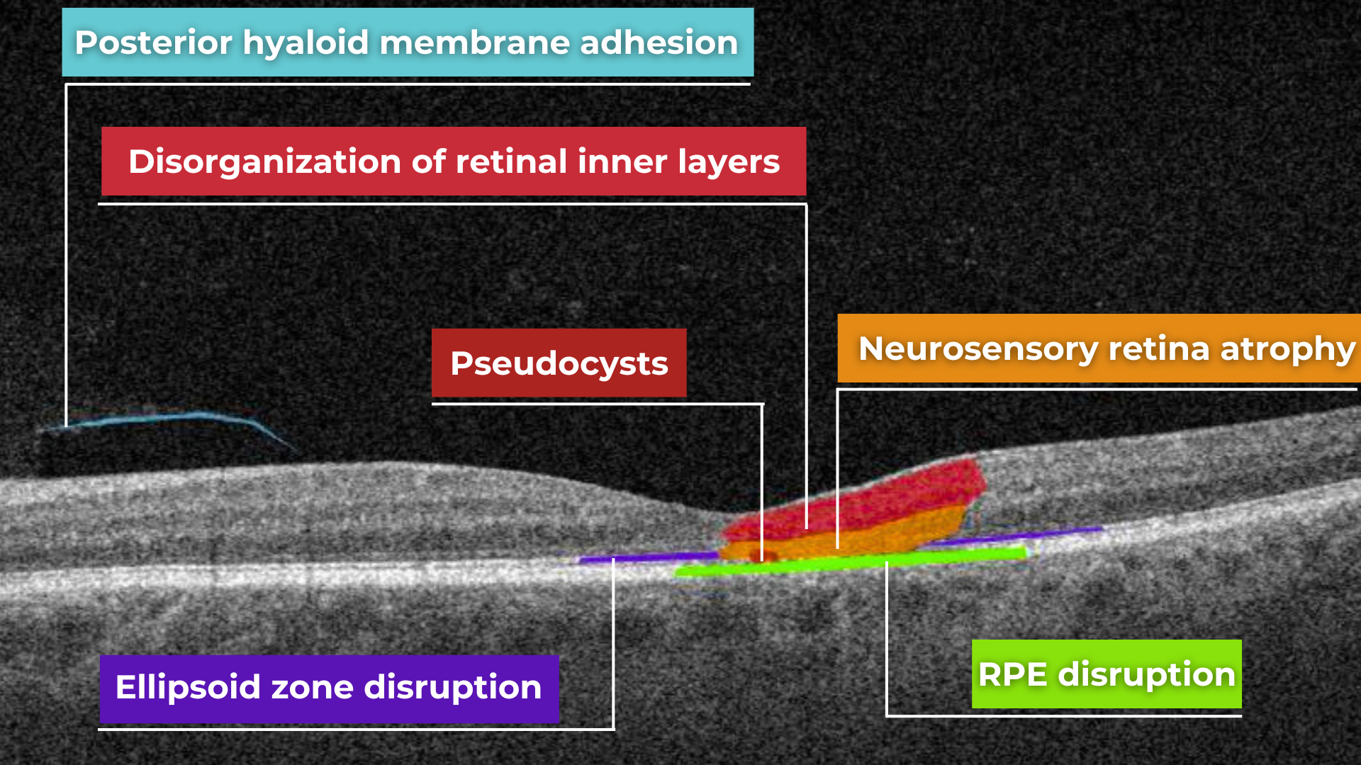 normal macula oct