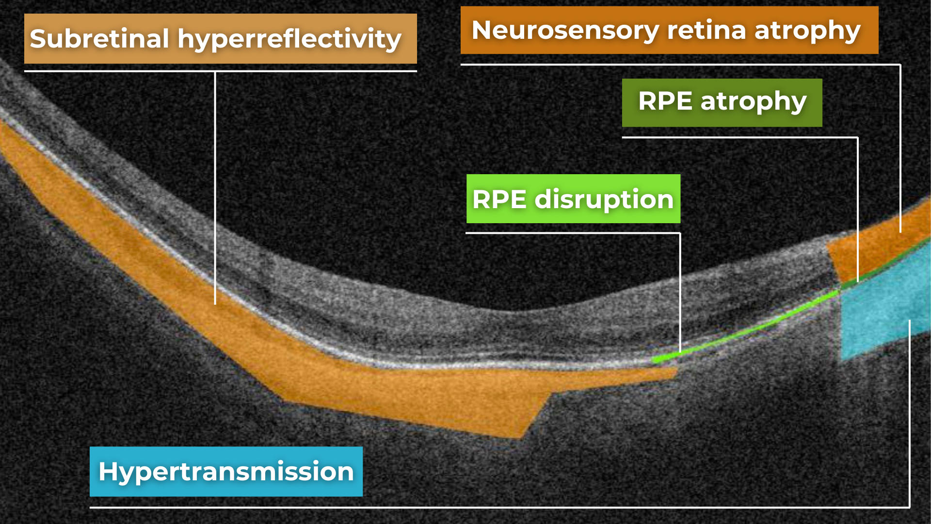 oct scan normal eye