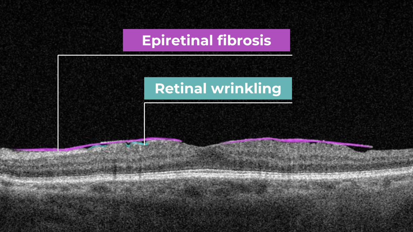 oct scan normal eye