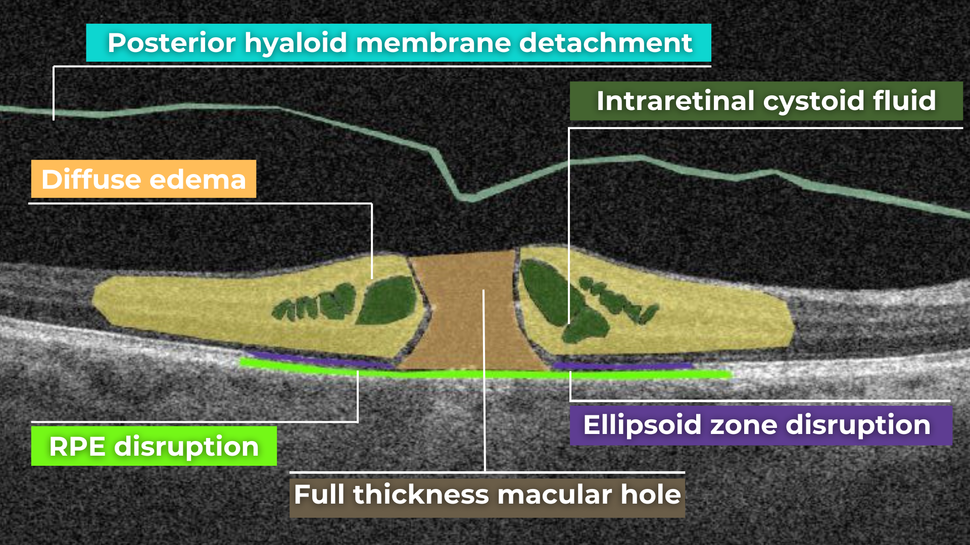 normal macula oct