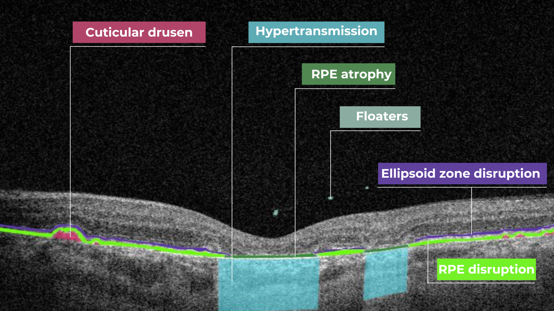 normal abnormal oct scan