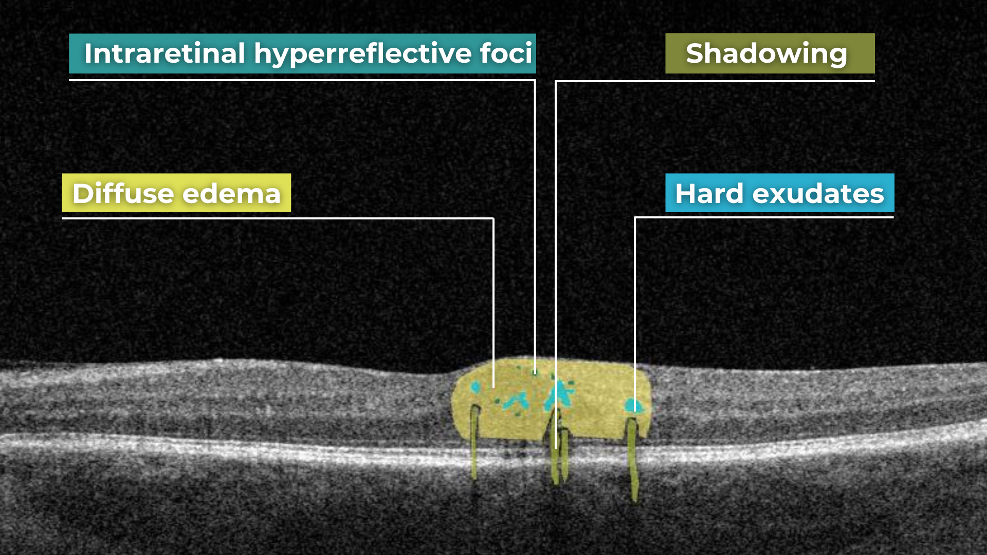 normal abnormal oct scan