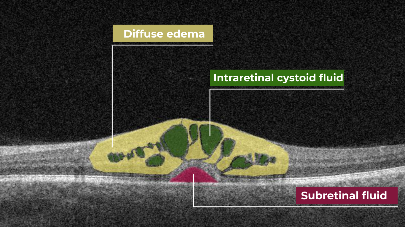 oct scan normal eye