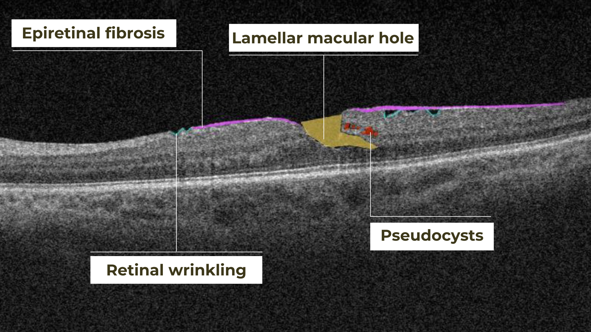 normal macula oct