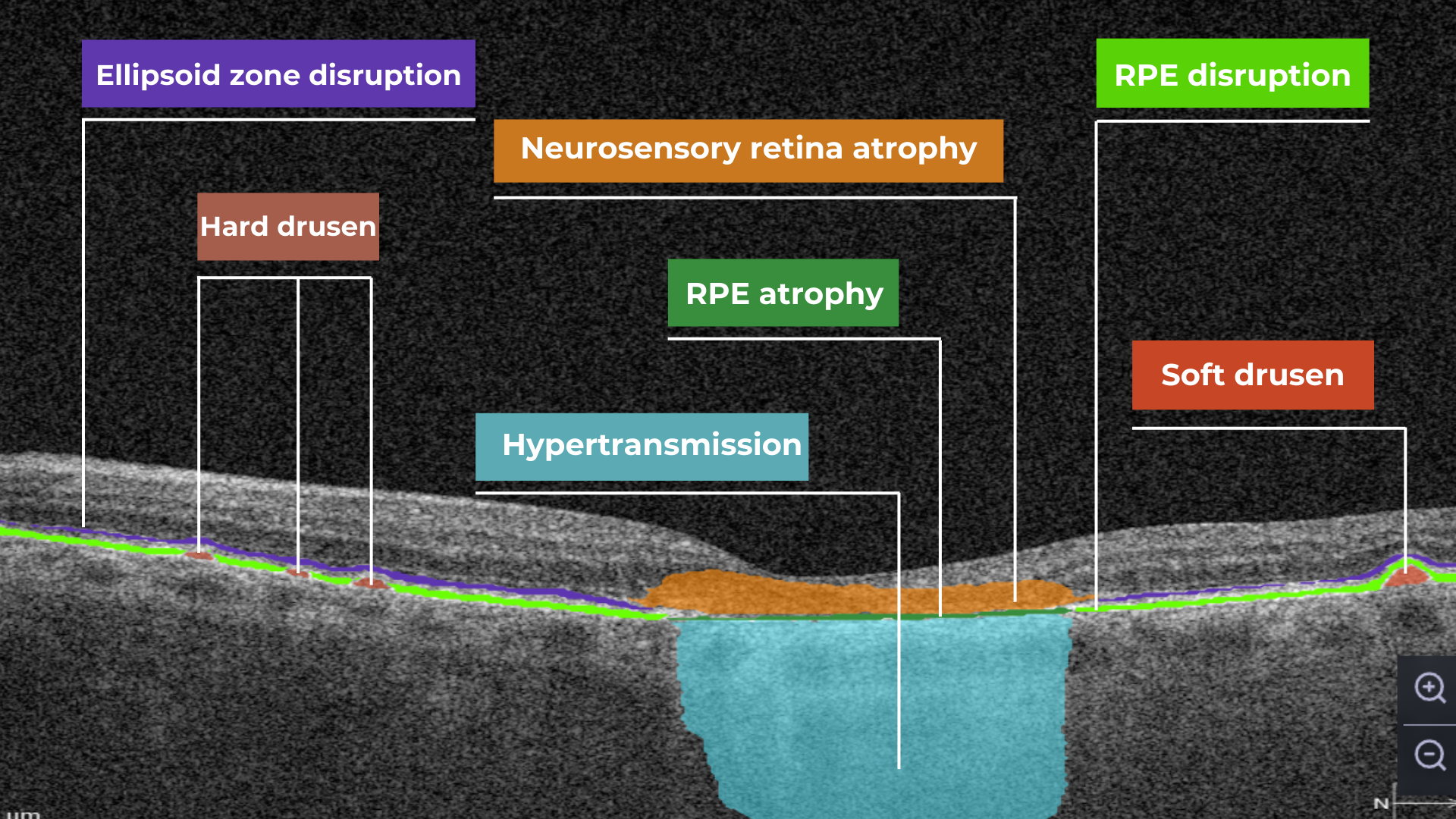 oct scan normal eye