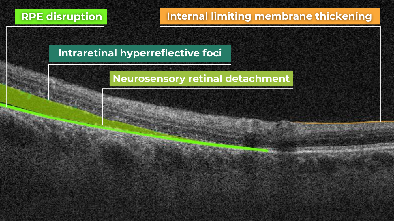 normal abnormal OCT scan