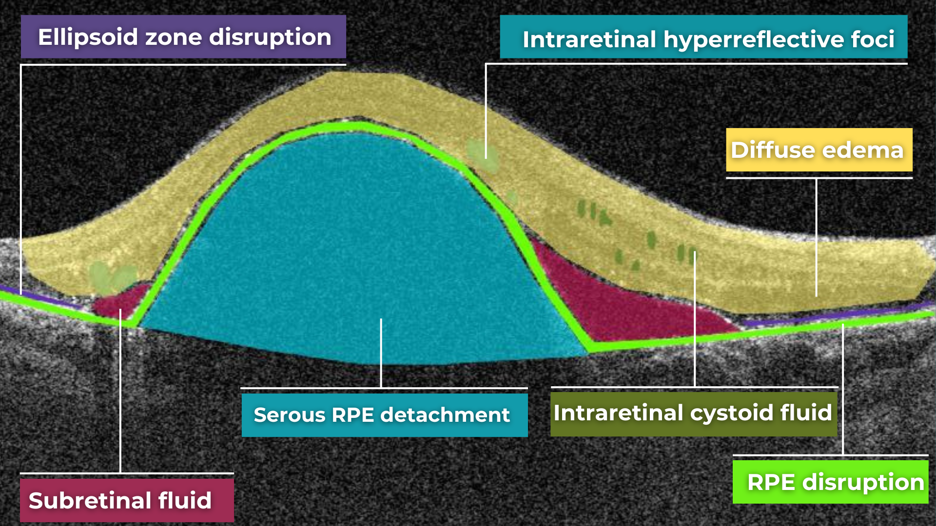 normal abnormal oct scan