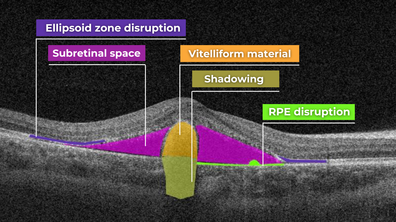 oct scan normal eye