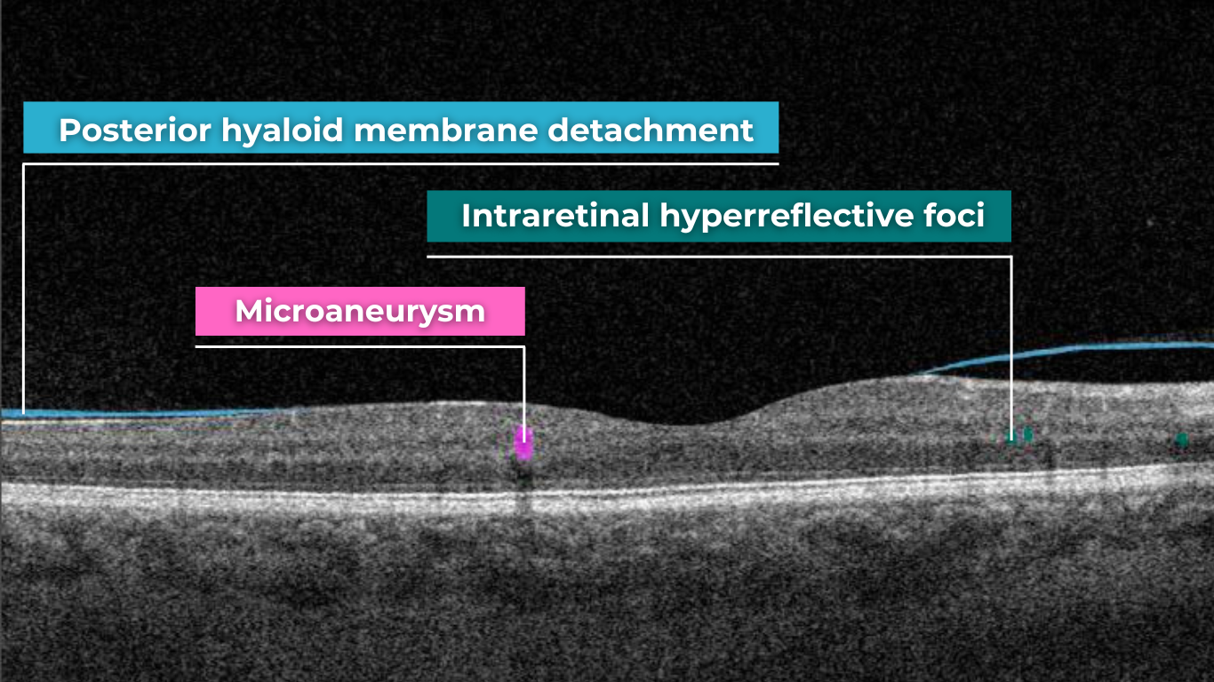 oct scan normal eye