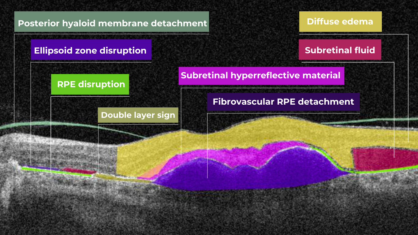 normal abnormal oct scan