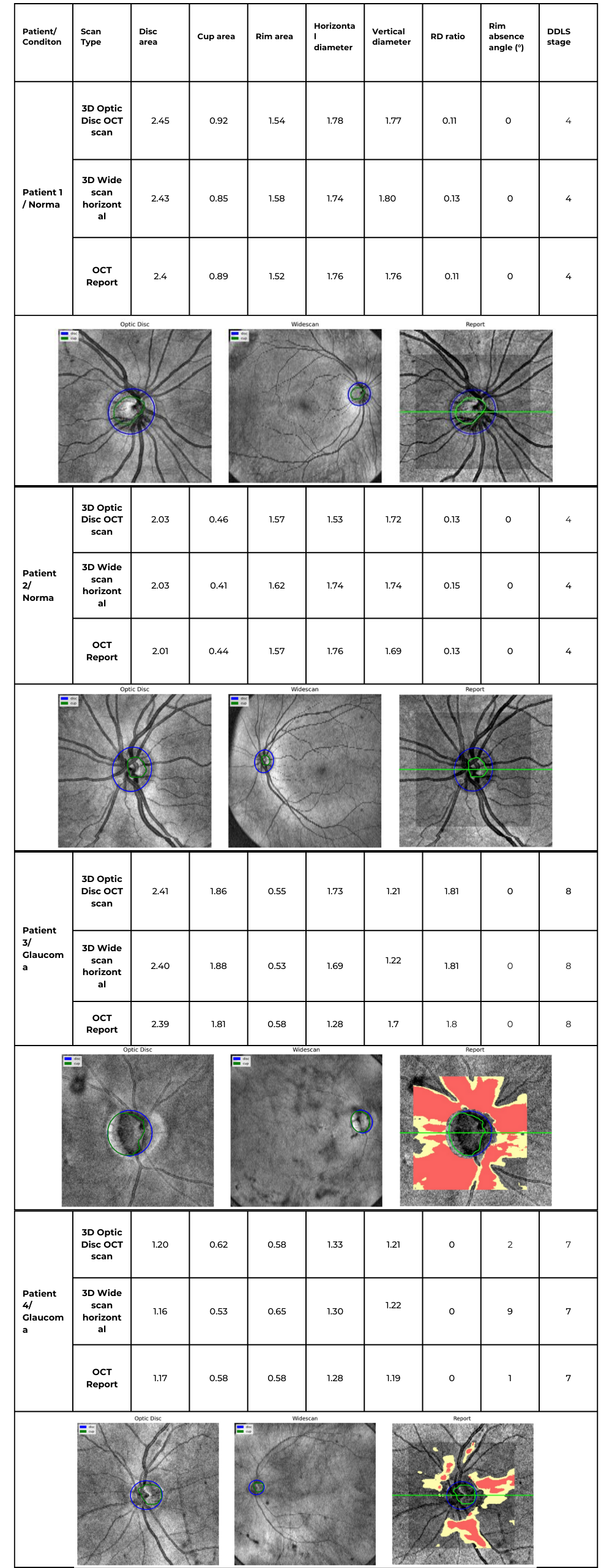 AI OCT Optic Disc Analysis