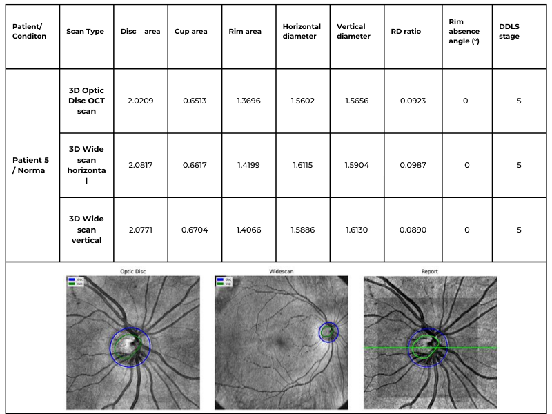 AI OCT Optic Disc Analysis